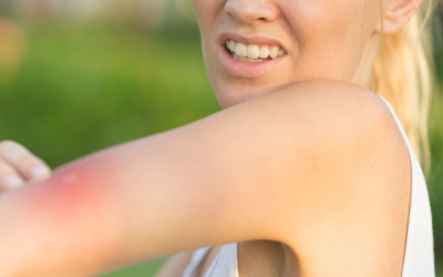 Prévenir et apaiser les piqûres de moustique en mode Naturo